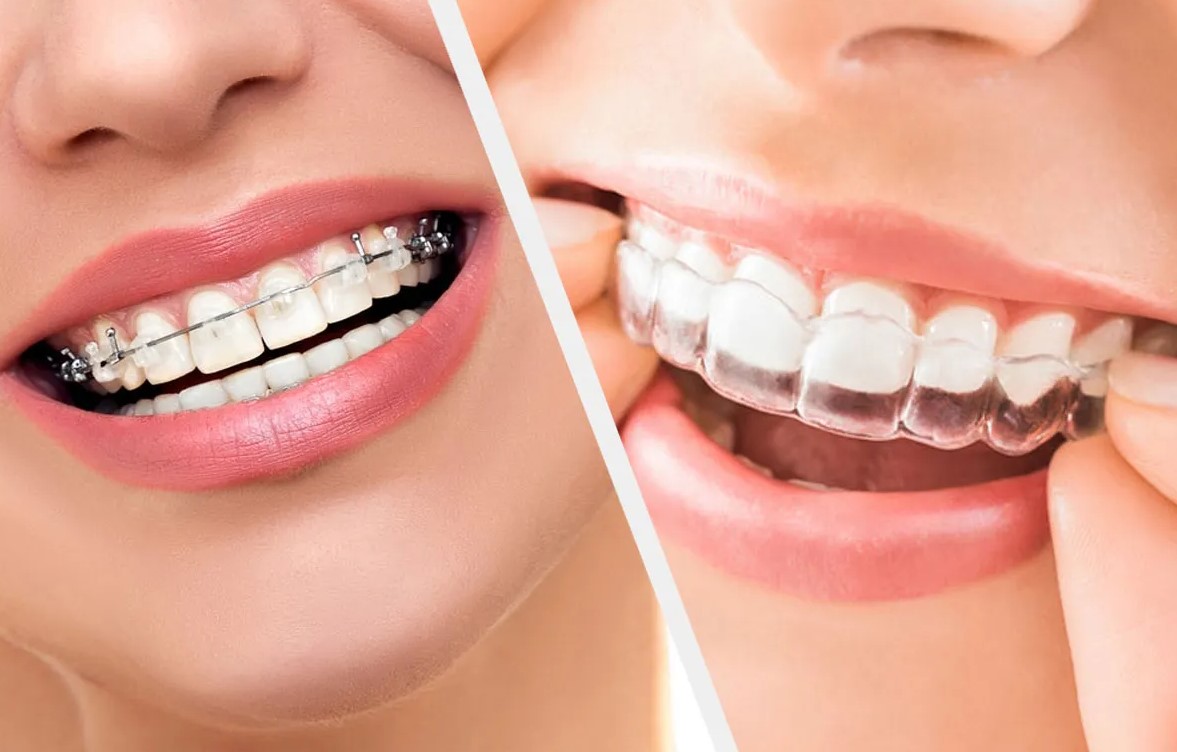 Braces vs. Invisalign