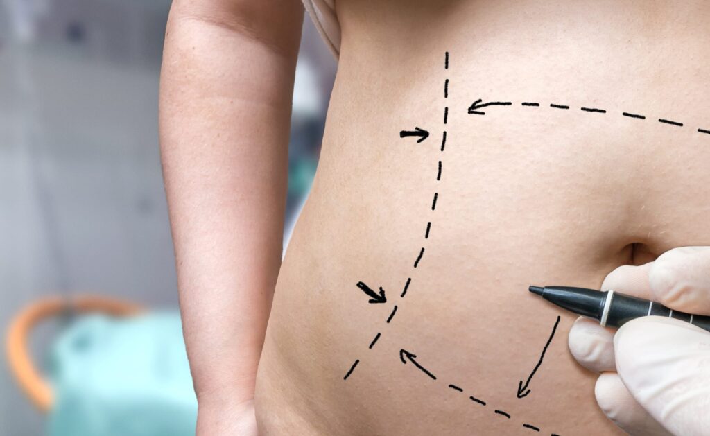 Liposuction Surgery in Dubai