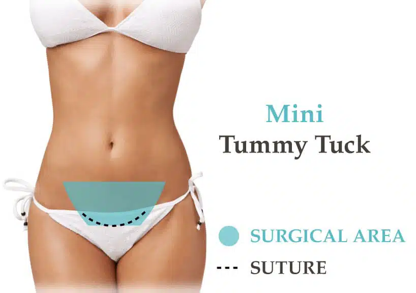 Mini Tummy Tuck in Dubai