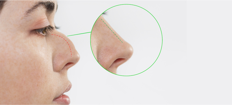 Rhinoplasty Surgery in Dubai