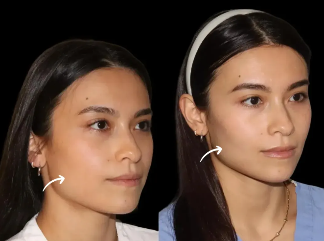 sculptra fillers in dubai