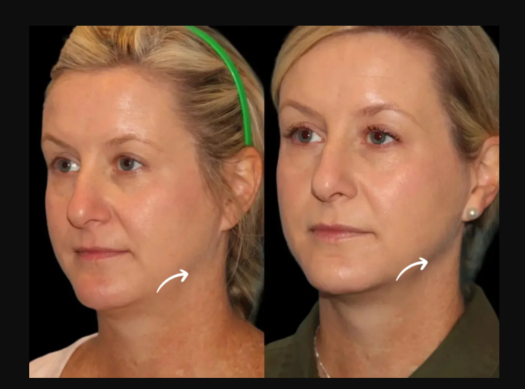 Sculptra Fillers Treatment in Dubai